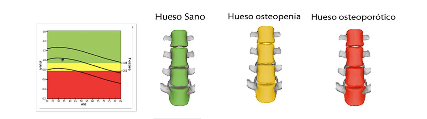 Estadísticas osteoporosis Chile