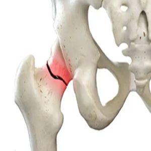 Fracturas frecuentes: